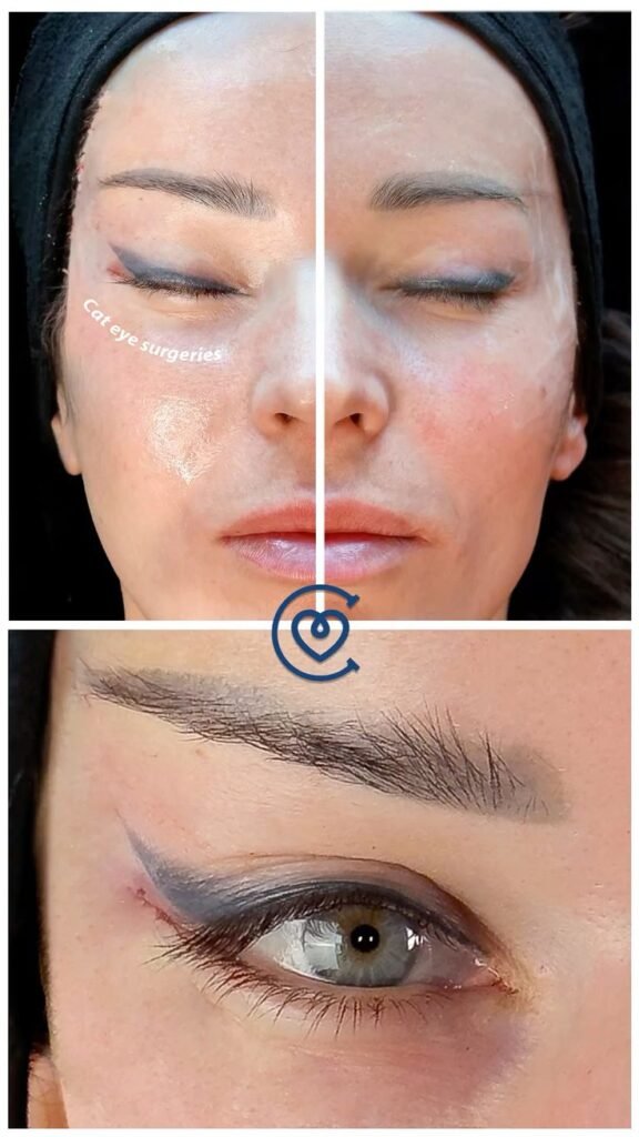 implants de joues pour un contour facial plus équilibré