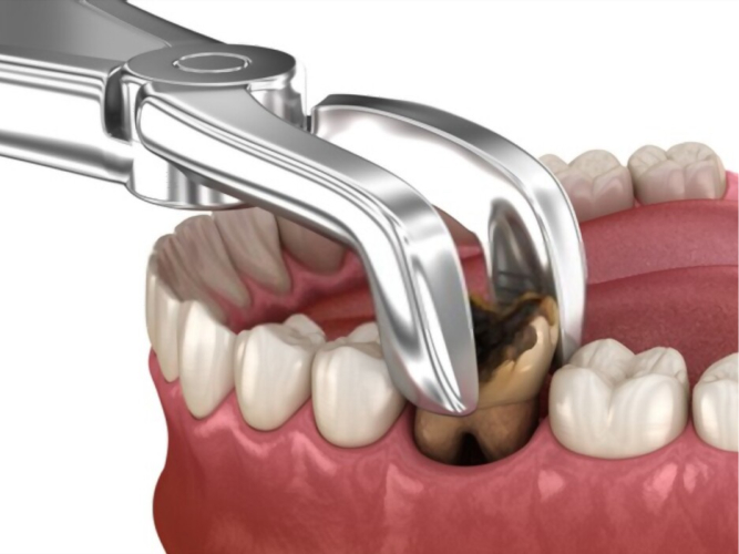 intervention de comblement sinusien réalisée par des spécialistes