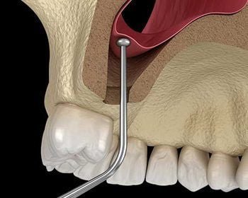 intervention de comblement sinusien réalisée par des spécialistes