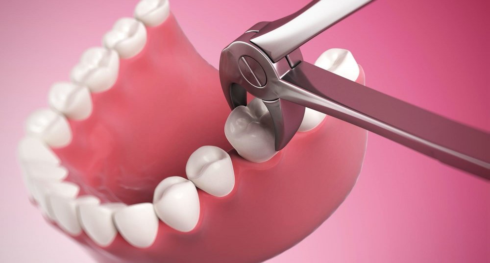 intervention d’extraction dentaire par des spécialistes