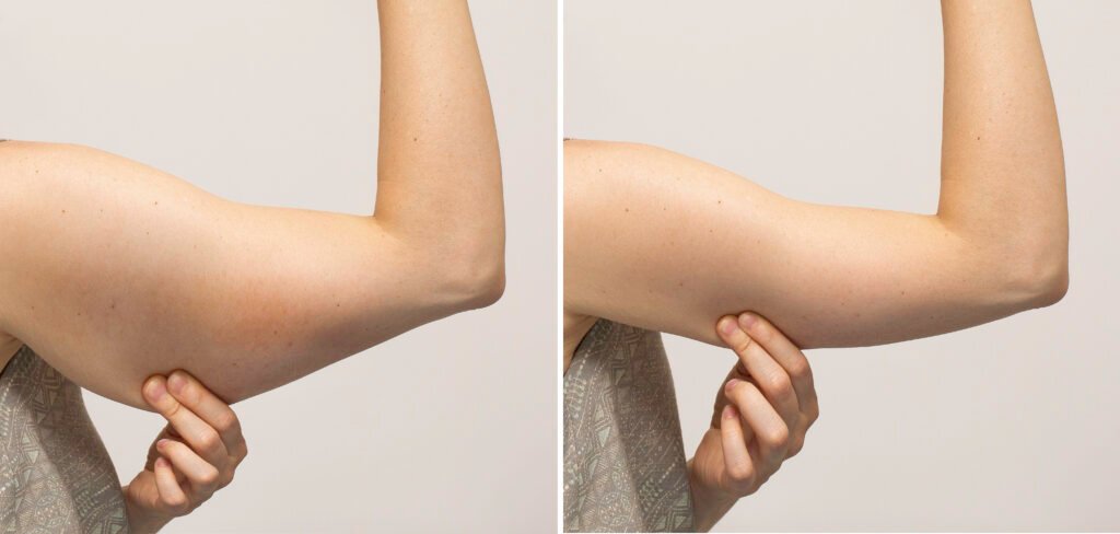 Lifting des bras pour améliorer le contour et la fermeté