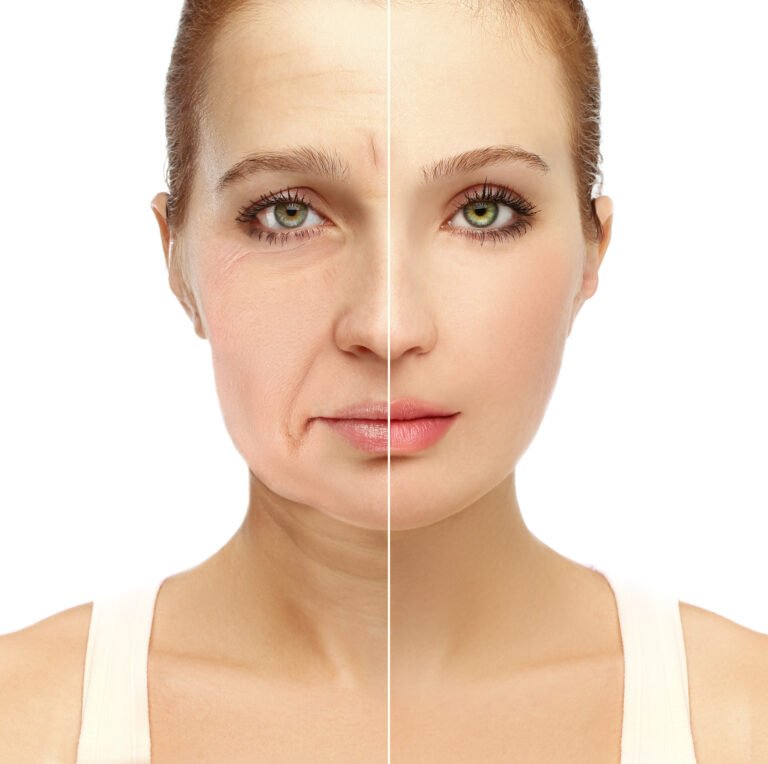 Lifting par fils tenseurs Spider Web pour réduire le relâchement cutané