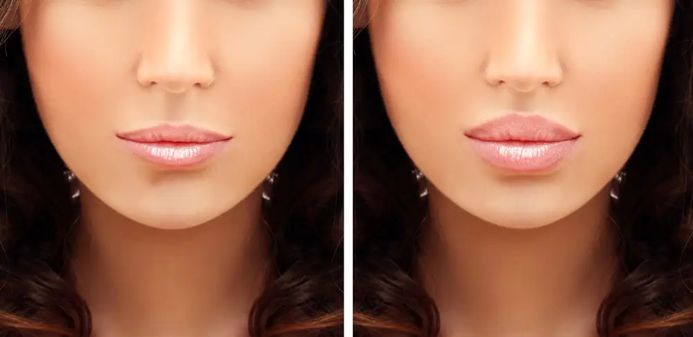 Réduction des lèvres : Prix en Turquie 2026