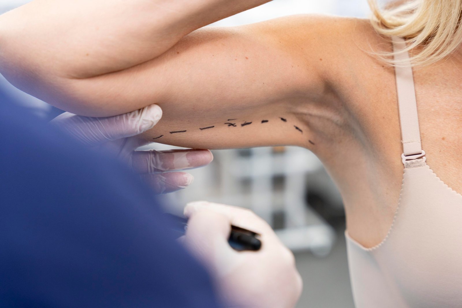 liposuccion des bras pour affiner la silhouette à cayra clinics