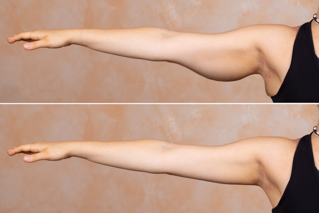 Liposuccion des bras pour réduire la graisse localisée