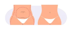 Mommy Makeover en Turquie : 10 points clés