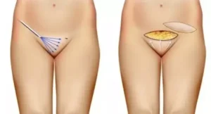 Génital esthétique en Turquie : 7 Solutions Intimes