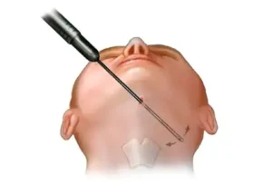 Liposuccion du cou en Turquie : Prix et Résultats