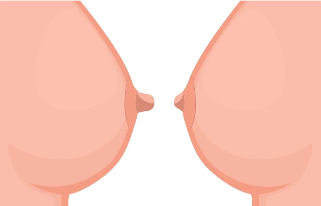 Réduction des Mamelons : Guide Complet 2026.