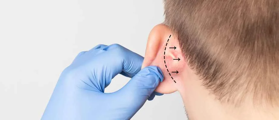 Otoplasty : 5 Infos Clés sur Prix, et Procédure.