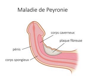 Maladie de La Peyronie : 7 Solutions Efficaces en Turquie
