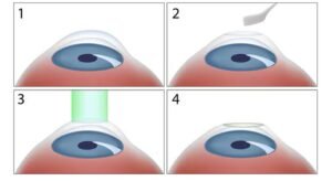 Chirurgie PRK en Turquie : 5 raisons de la choisir