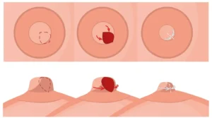 Réduction des Mamelons : 10 Informations Essentielles à Connaître