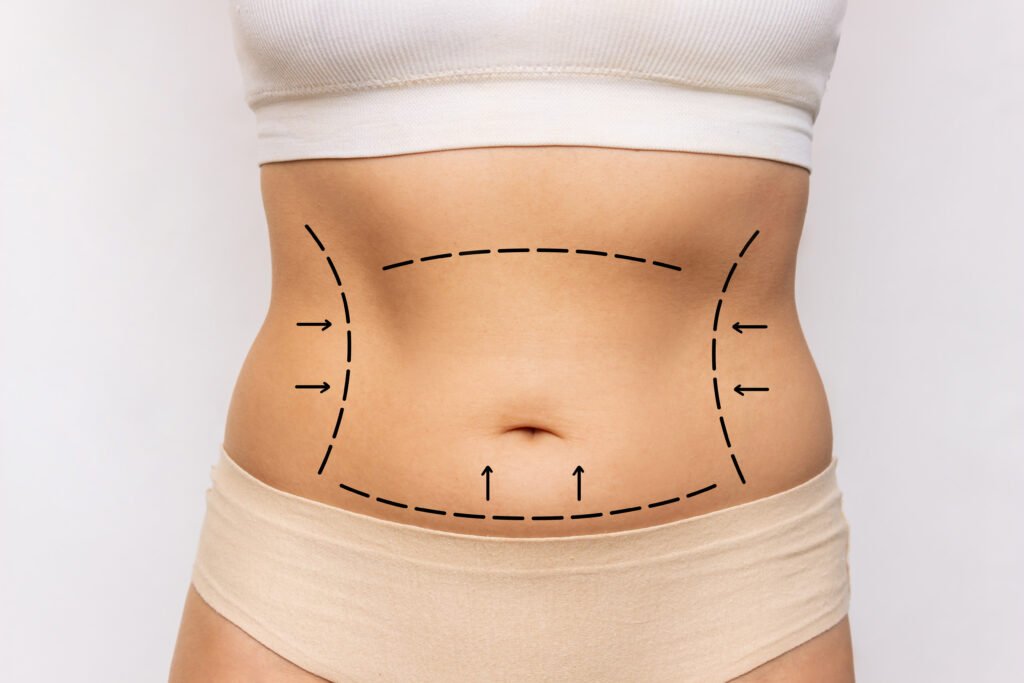 résultat avant et après mini abdominoplastie