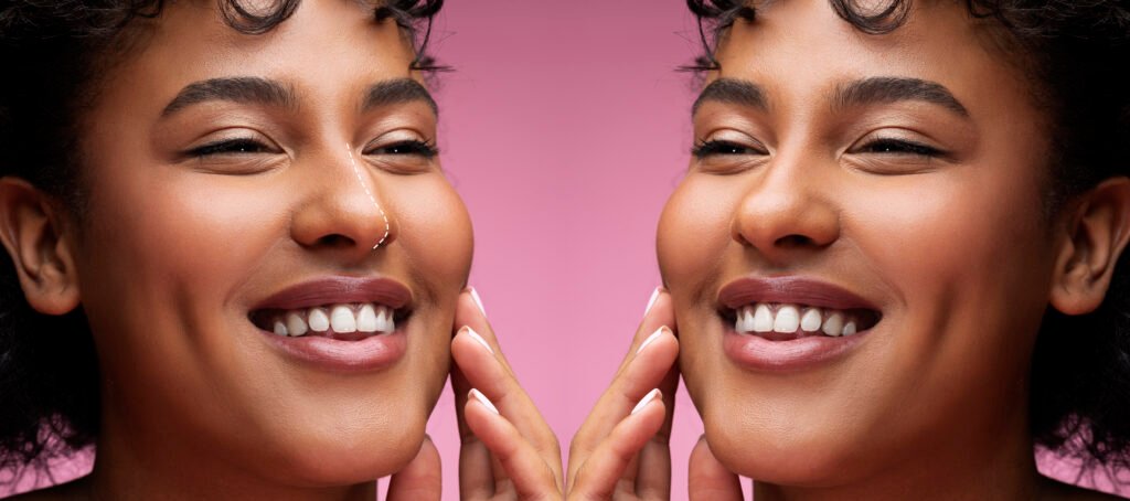 résultat naturel de rhinoplastie ethnique respectant les traits du visage