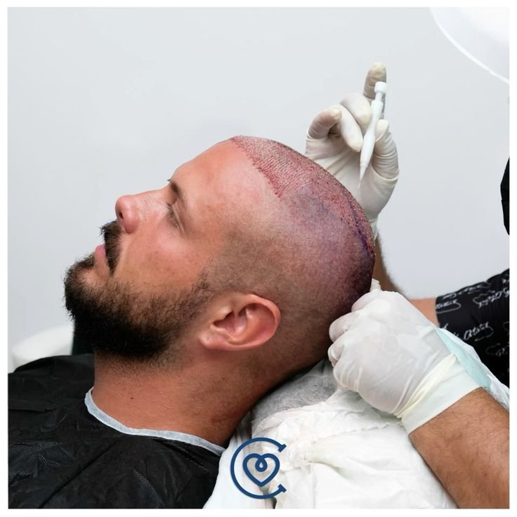 résultats avant et après d’une greffe de cheveux dhi