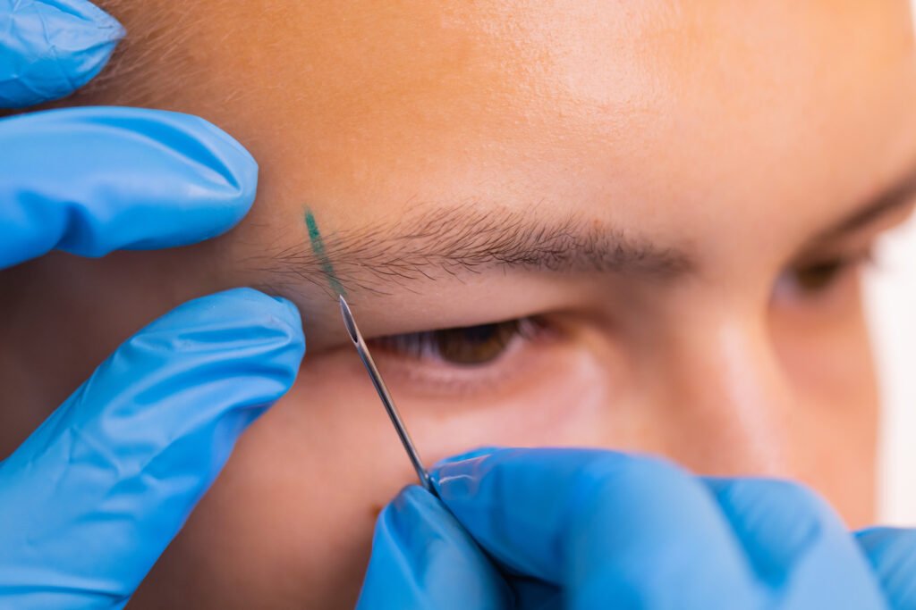 Résultats avant et après d’une greffe de sourcils naturelle