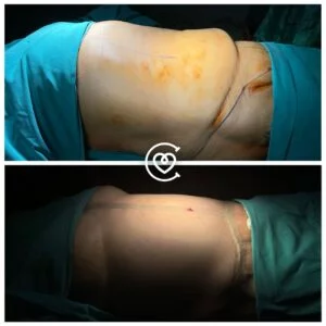 retrait de la graisse localisée pour un abdomen plus ferme