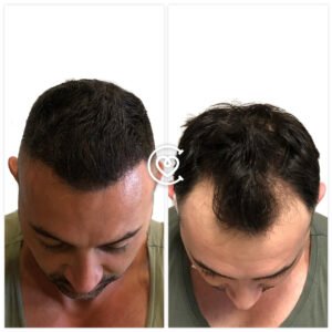 Greffe de cheveux au saphir avant et après