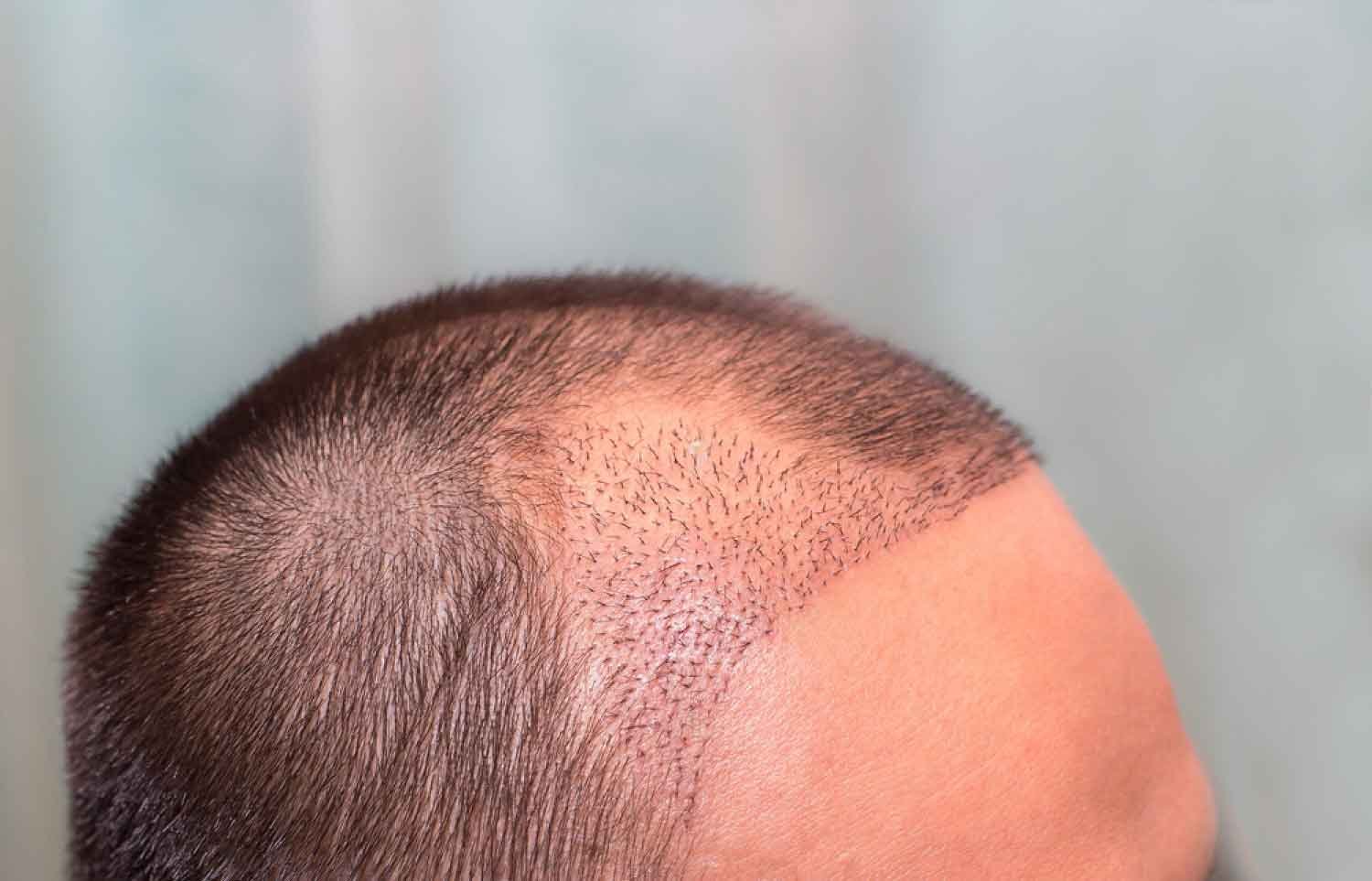 saç ekimi uygulaması