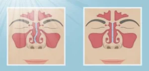 Septoplastie pour la déviation de la cloison nasale