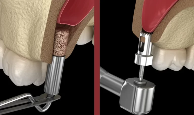 sinus lift avant implants pour une base osseuse solide