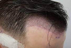 solution contre la chute des cheveux