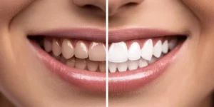 Blanchiment des dents en Turquie : 7 méthodes et avantages