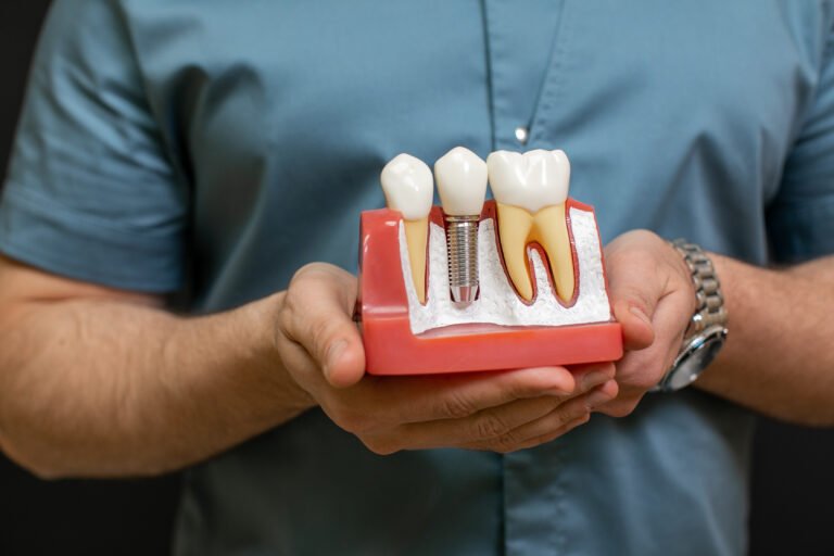 traitement all on 4 avec implants dentaires pour édentation complète