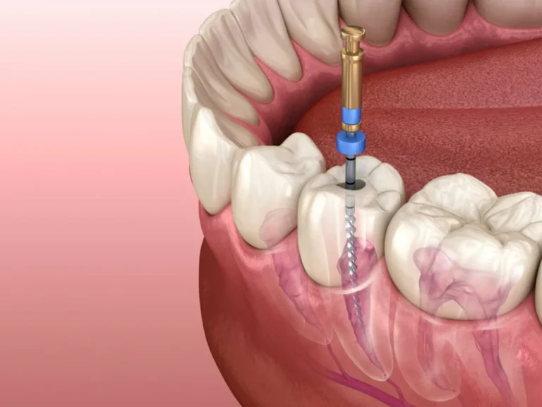 traitement endodontique moderne pour préserver la santé dentaire