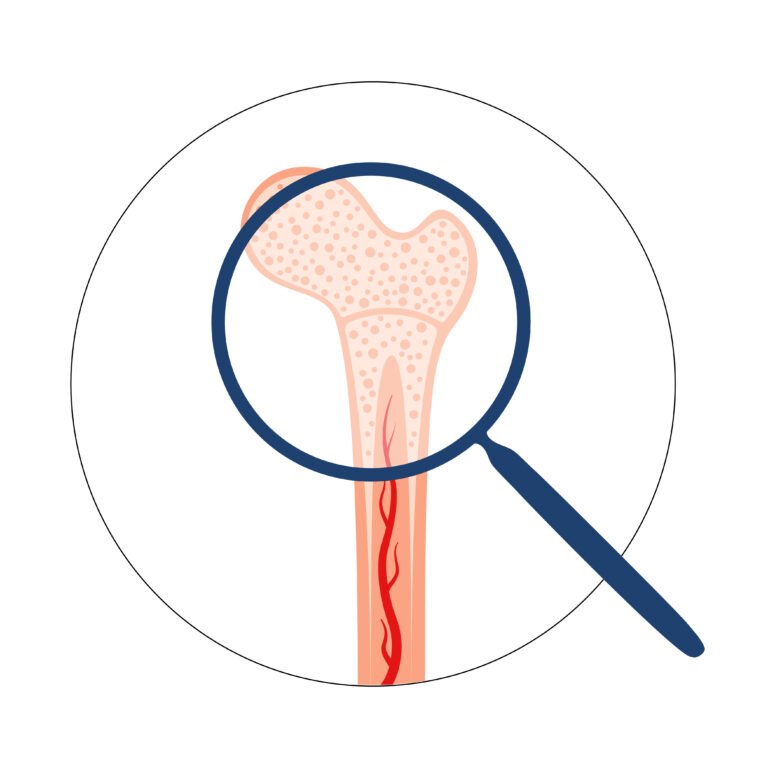 Traitement par transplantation de moelle osseuse pour maladies hématologiques