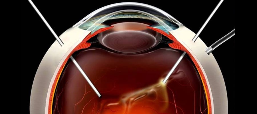 traitement rétinien avancé avec vitrectomie en turquie