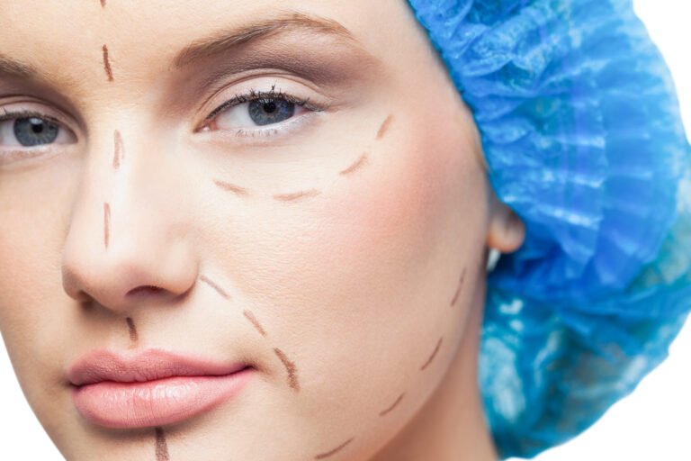 traitement spider web pour un effet lifting naturel et non chirurgical