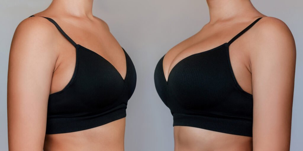 transfert de graisse pour augmenter le volume des seins