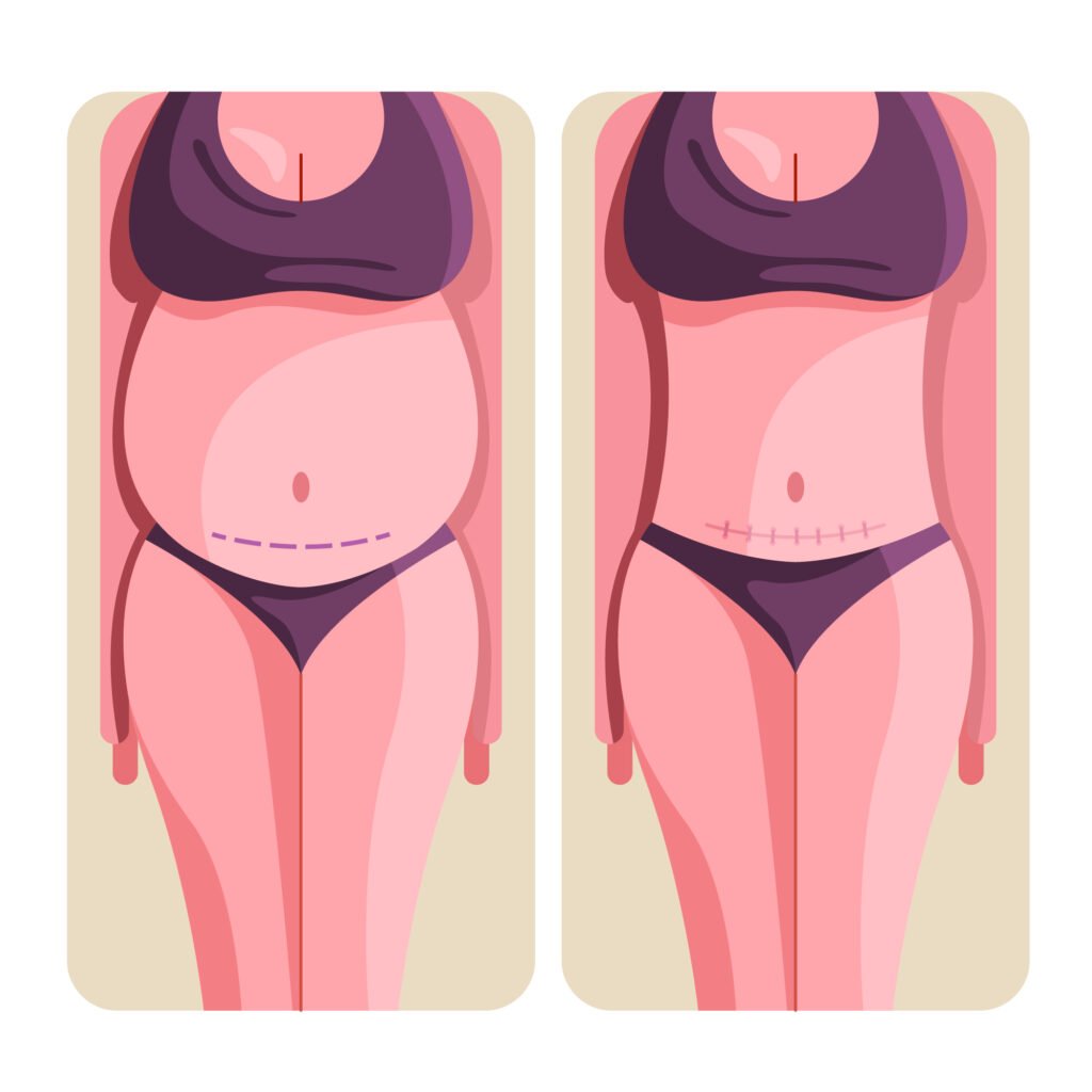 transformation avant après abdominoplastie