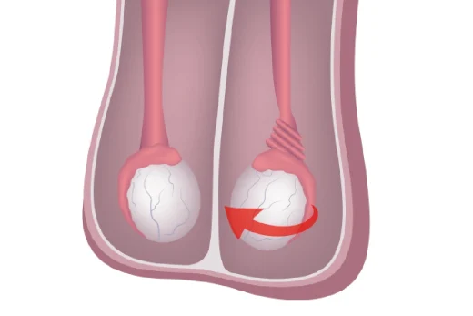 Opération varicocèle : 7 points clés en Turquie