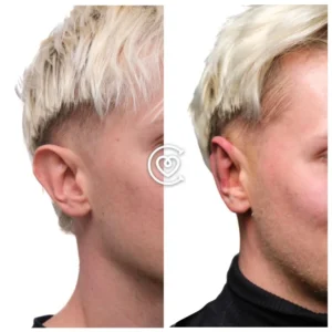 Otoplasty : 5 Infos Clés sur Prix, et Procédure.