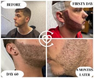 greffe de barbe avant et après