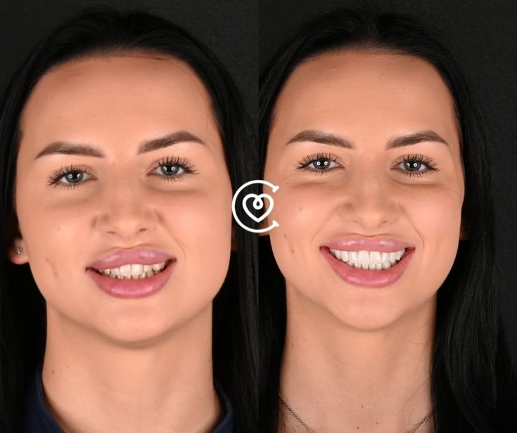 blanchiment dentaire pour un sourire éclatant