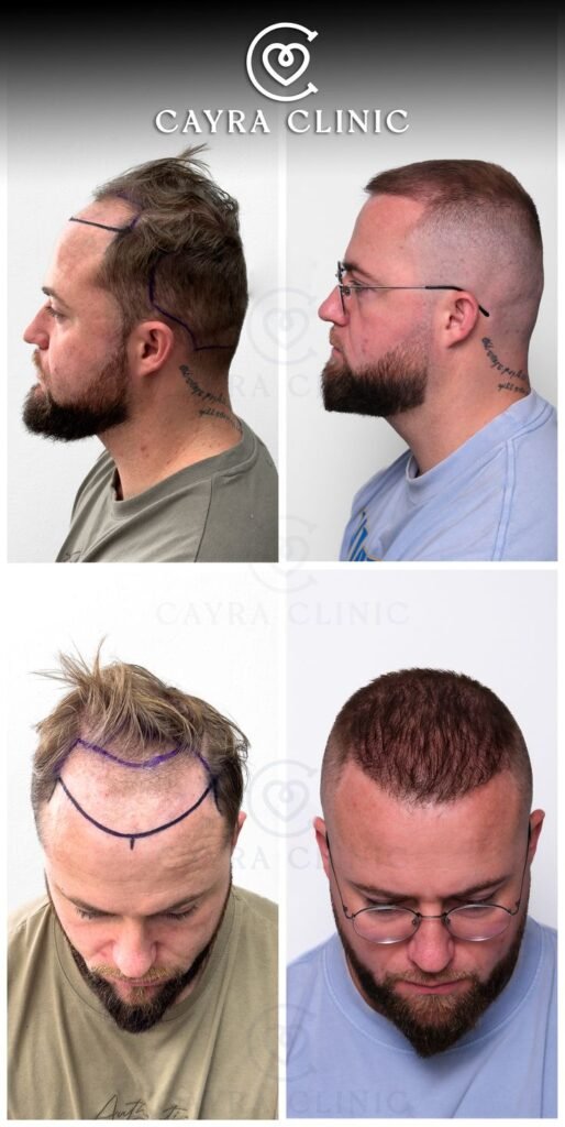 chirurgiens spécialisés avec une grande expérience en transplantation capillaire