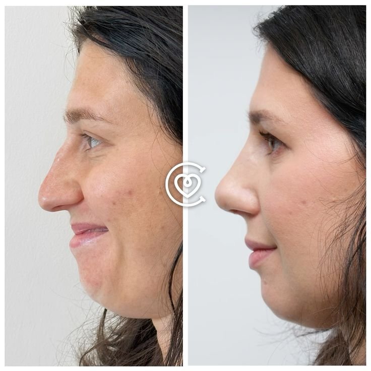 chirurgiens spécialisés en rhinoplastie avec grande expérience