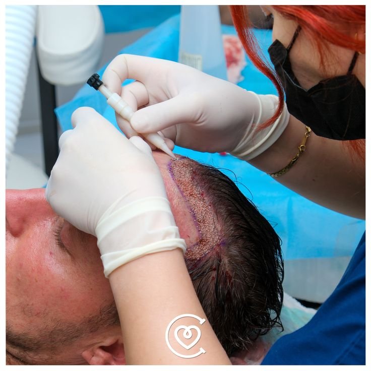 cliniques spécialisées en greffe de cheveux en turquie