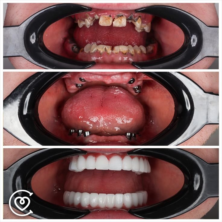 implants dentaires pour restaurer les dents manquantes