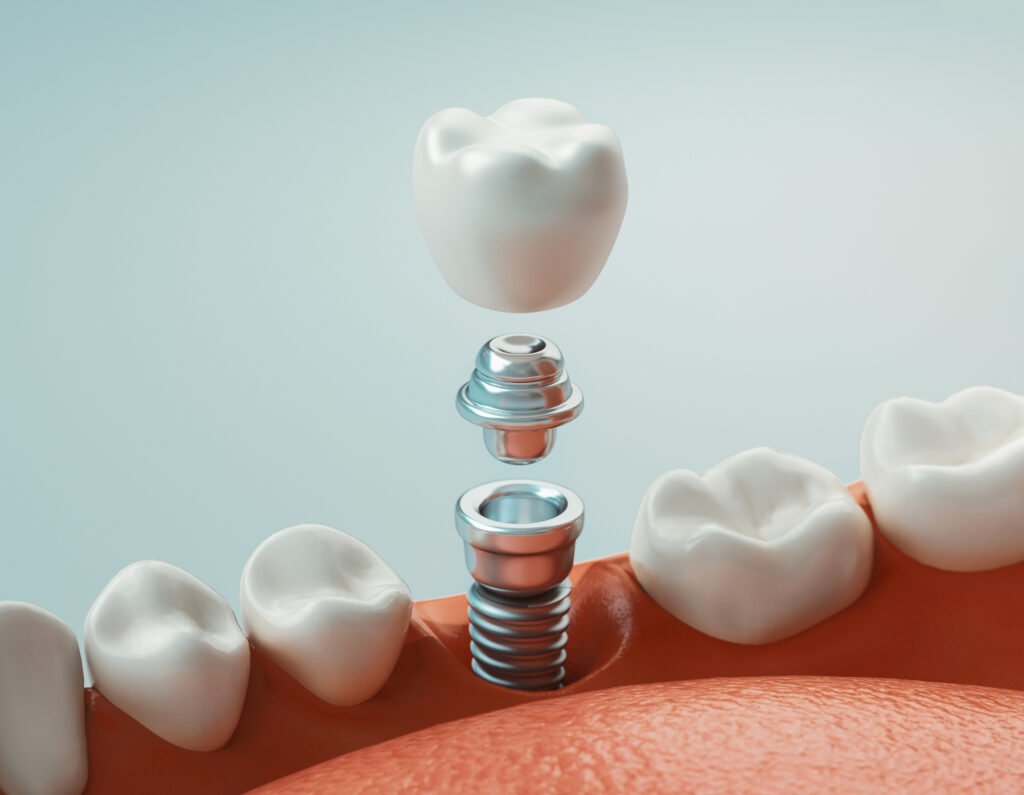 la turquie est elle spécialisée en implants dentaires à cayra clinics