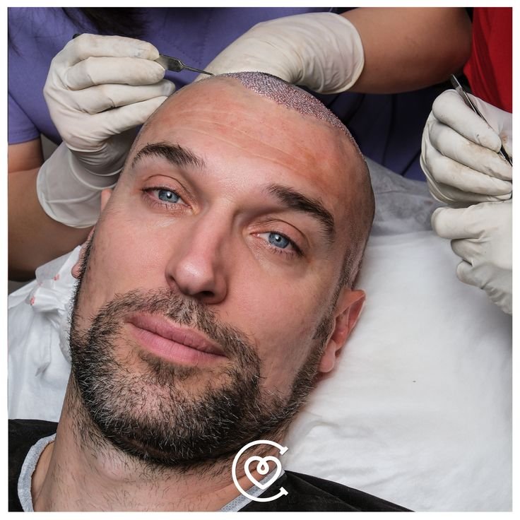 quels sont les avantages d’une greffe de cheveux en turquie à cayra clinics