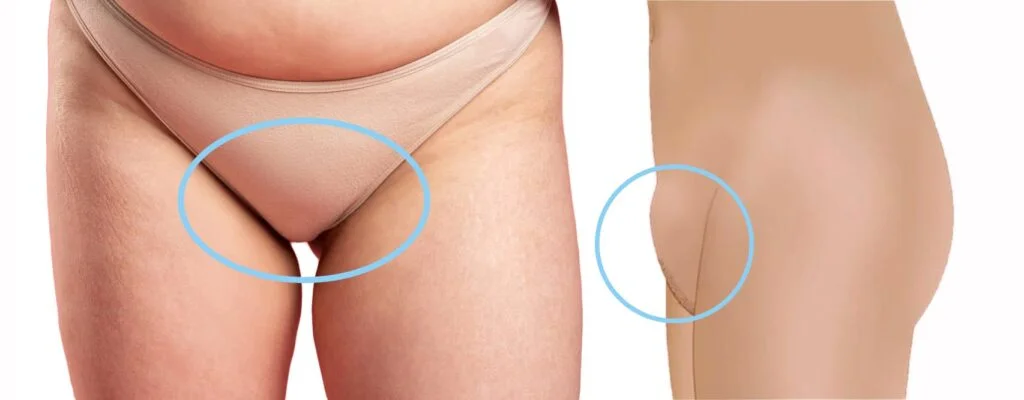 résultat avant et après chirurgie de la zone pelvienne supérieure