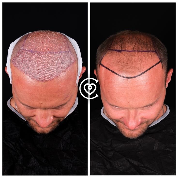 transplantation capillaire avancée avec résultats naturels