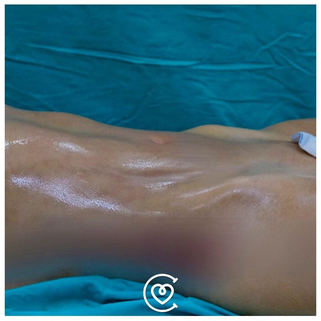 Liposuccion VASER Haute Définition à Istanbul, résultat sculpté