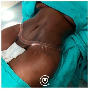 Définition musculaire après liposuccion VASER à Istanbul