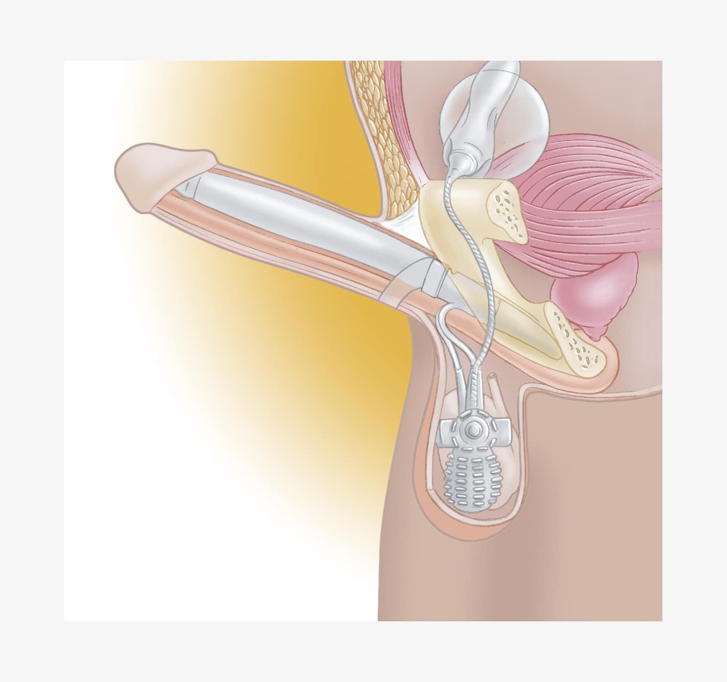 Implant pénien